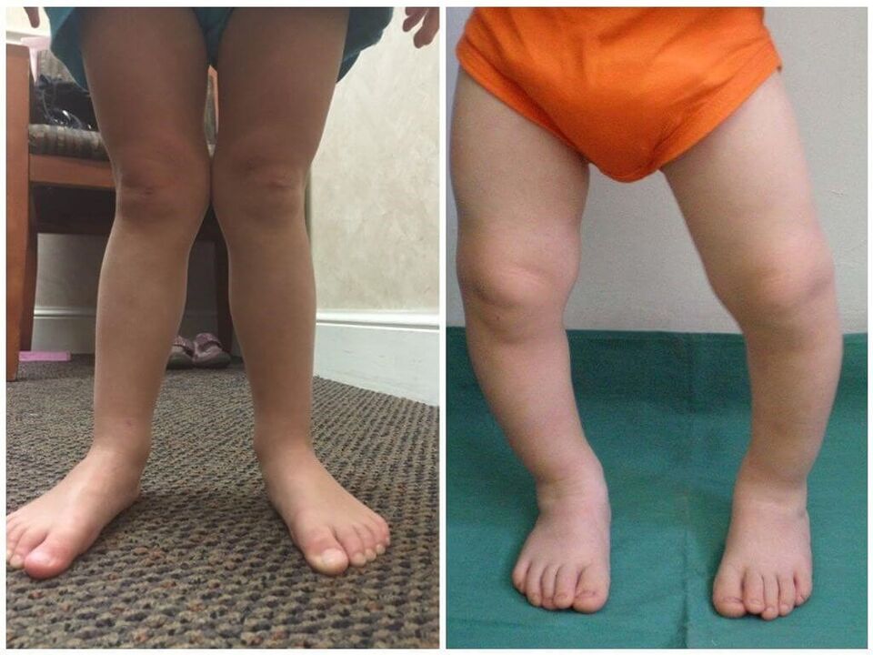 Déformation valgus causée chez les enfants