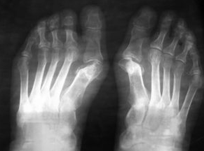 Indications pour les opérations sous le valgus du pied