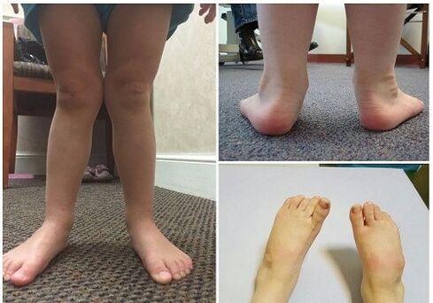 Déformation valgus chez les enfants