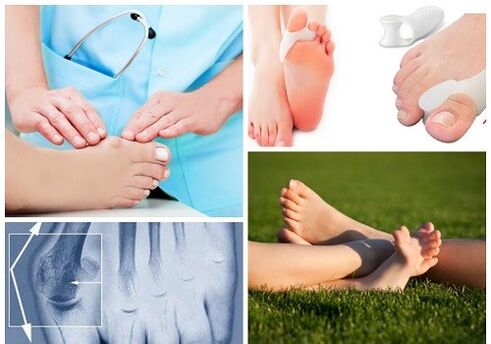 Traitement de la déformation valgus
